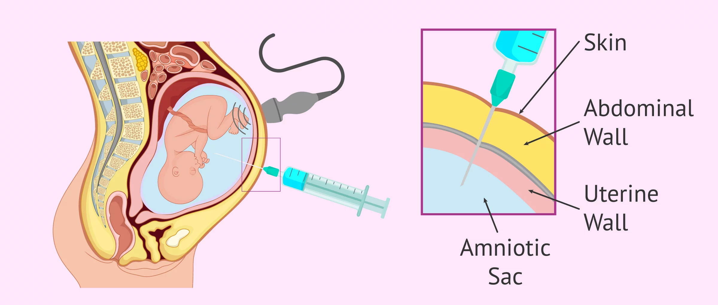 Should You Consider Amniocentesis After 35? Understanding Your Options