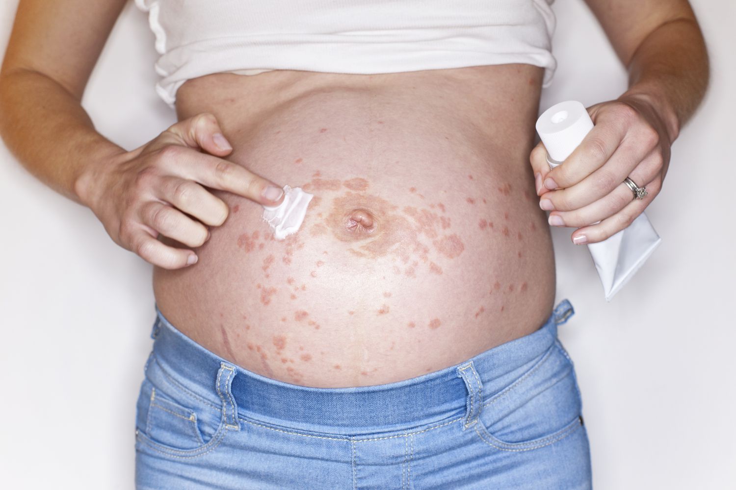 Skin Issues in the Third Trimester of Pregnancy